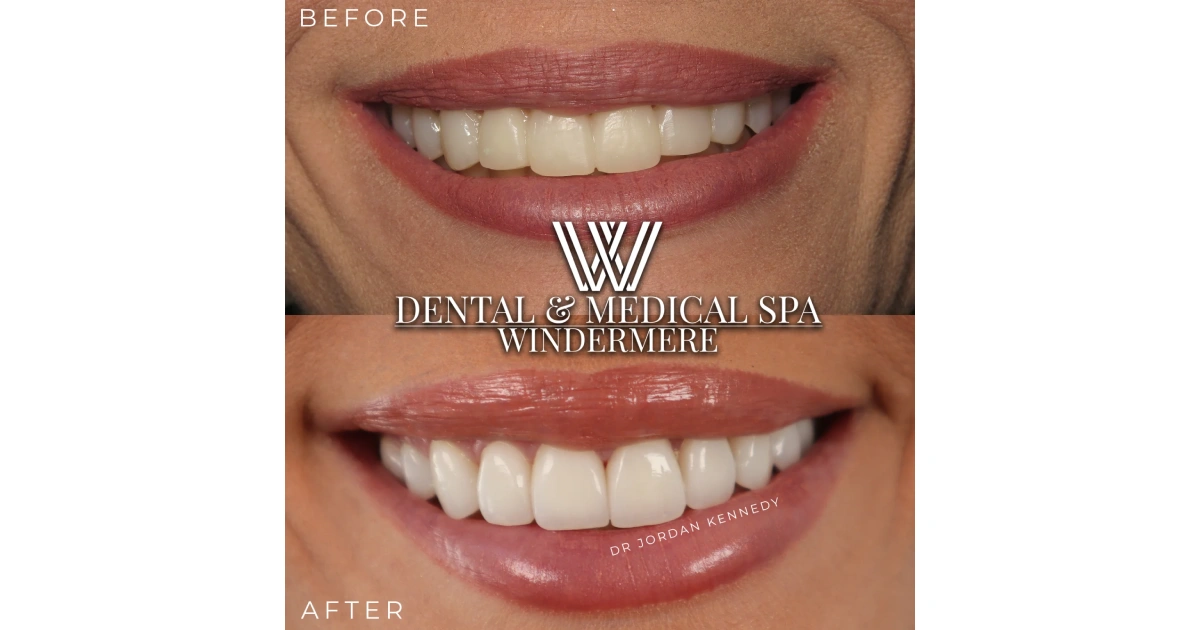 Veneers in Orlando, FL Windermere Dental & Medical Spa