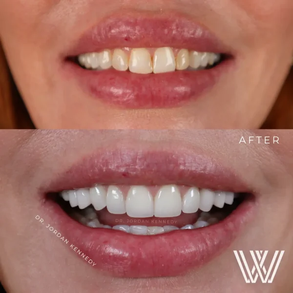 VENEERS IN ORLANDO, FL