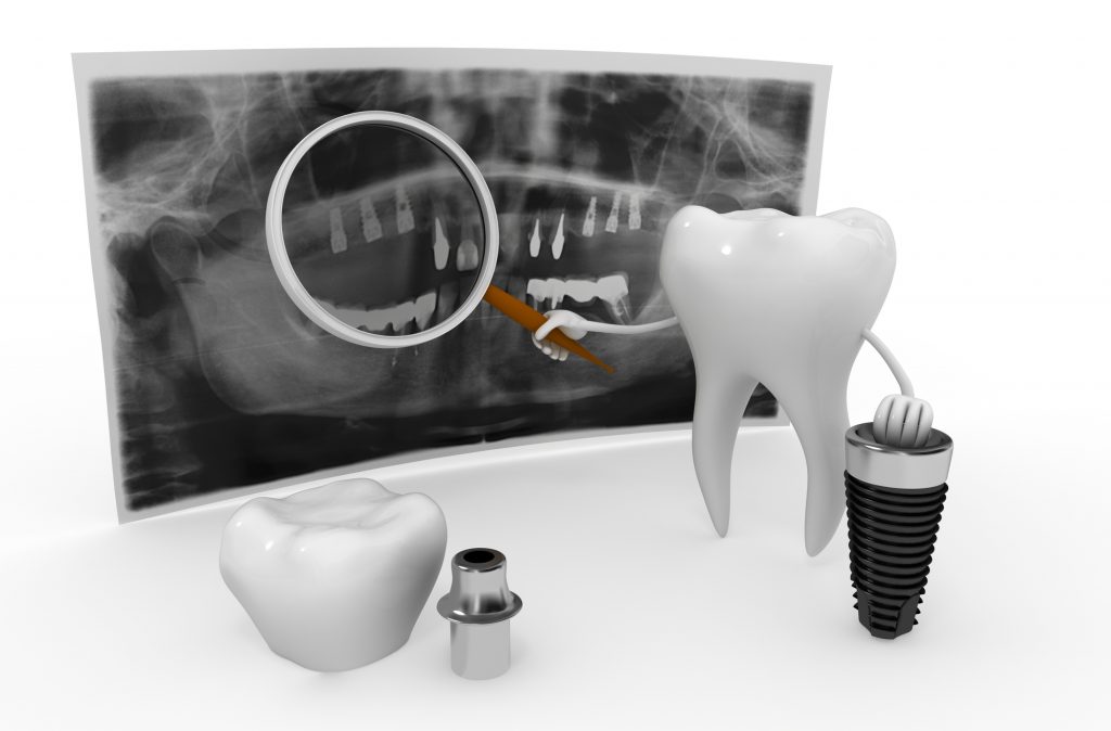 who are the best dental implants in orlando experts?