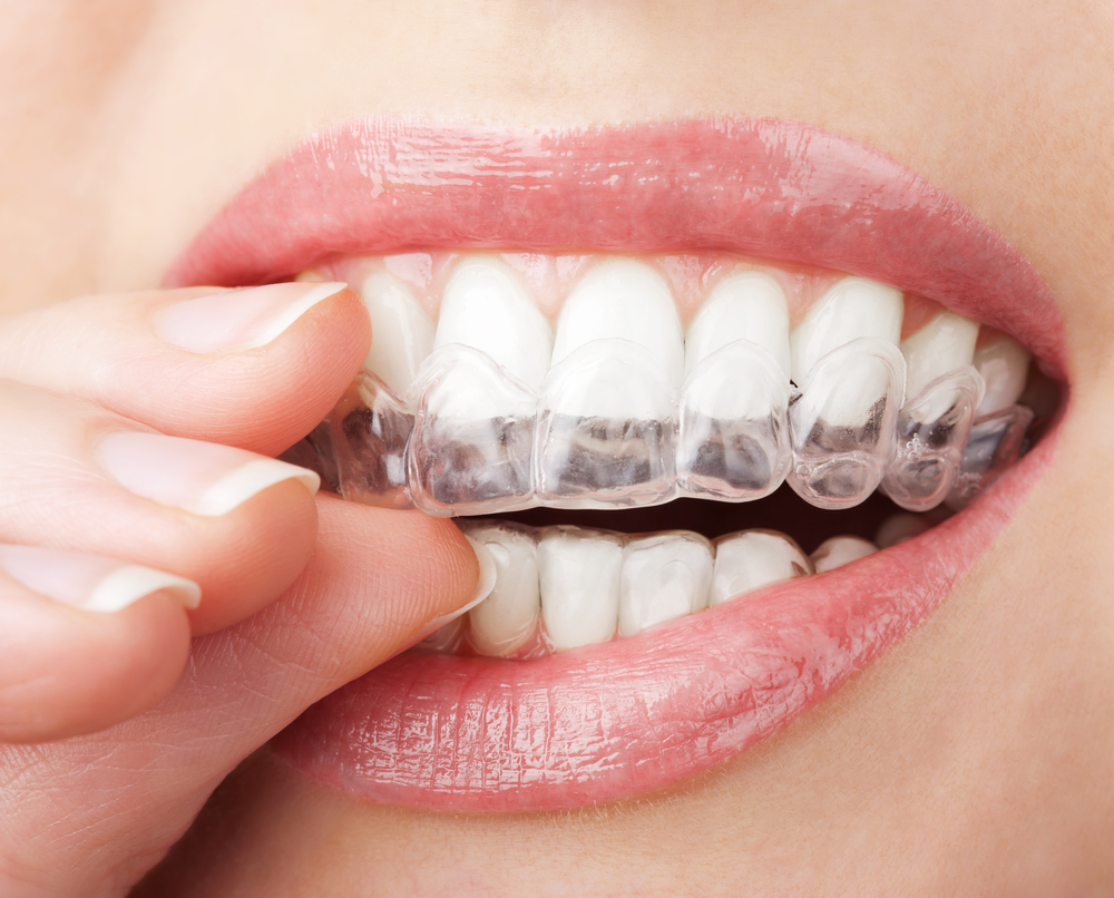 who can help me find the best invisalign in orlando?