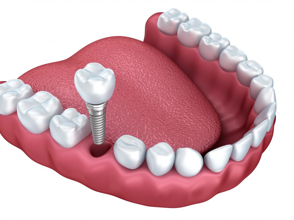 Where are the best dental implants orlando?