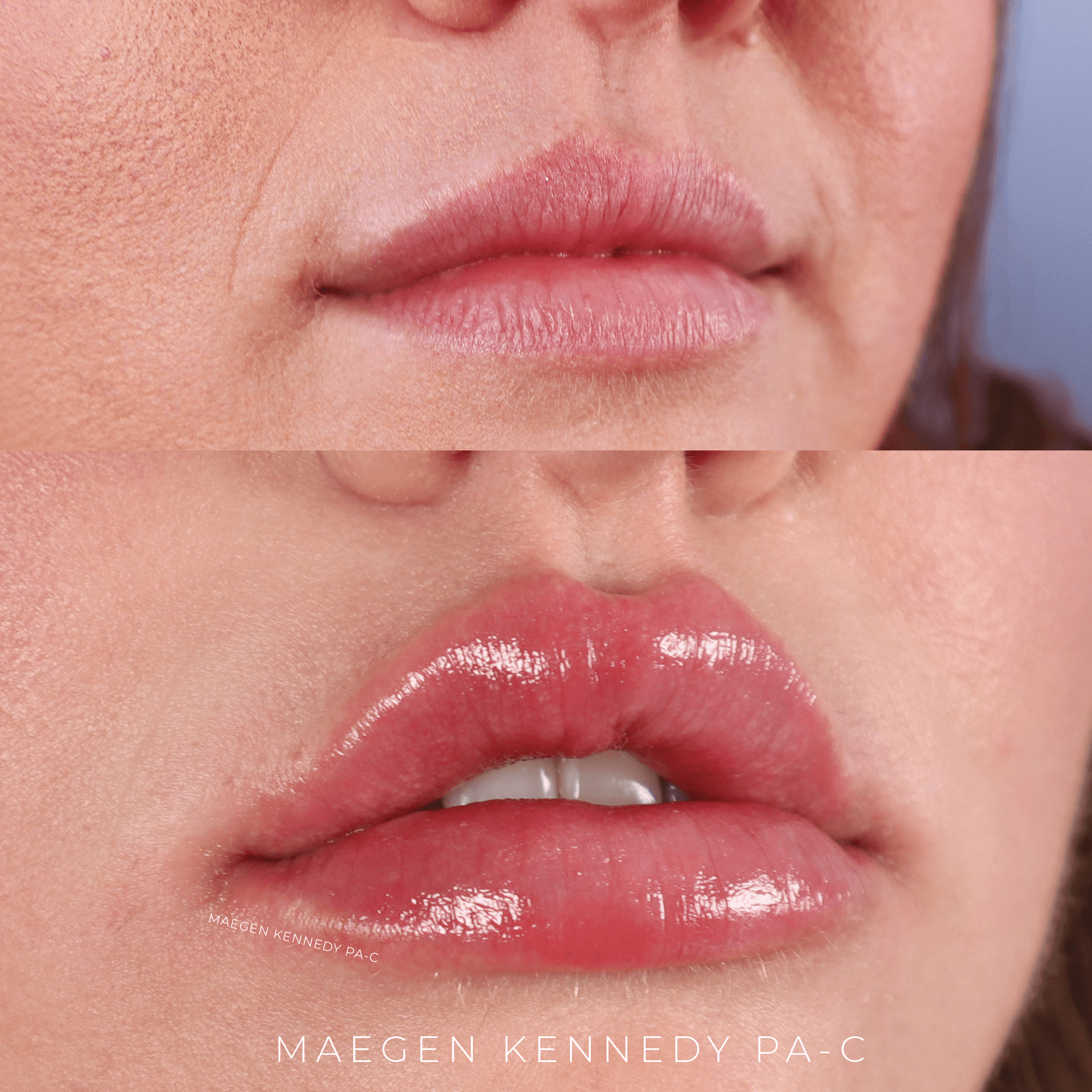best lip injections orlando FL 32836
