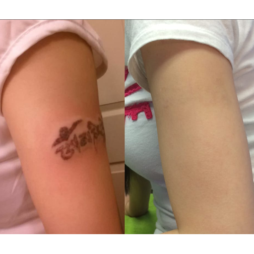 Tattoo Removal in Panama City  Sun Dermatology  Panama City Florida