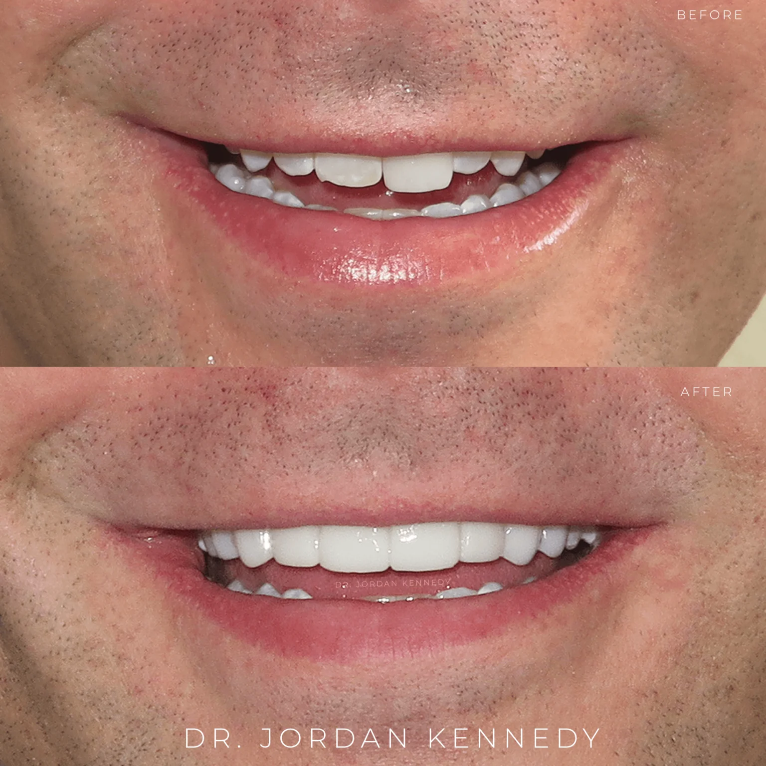veneers-Close-Up-dental-medical-spa-orlando-FL